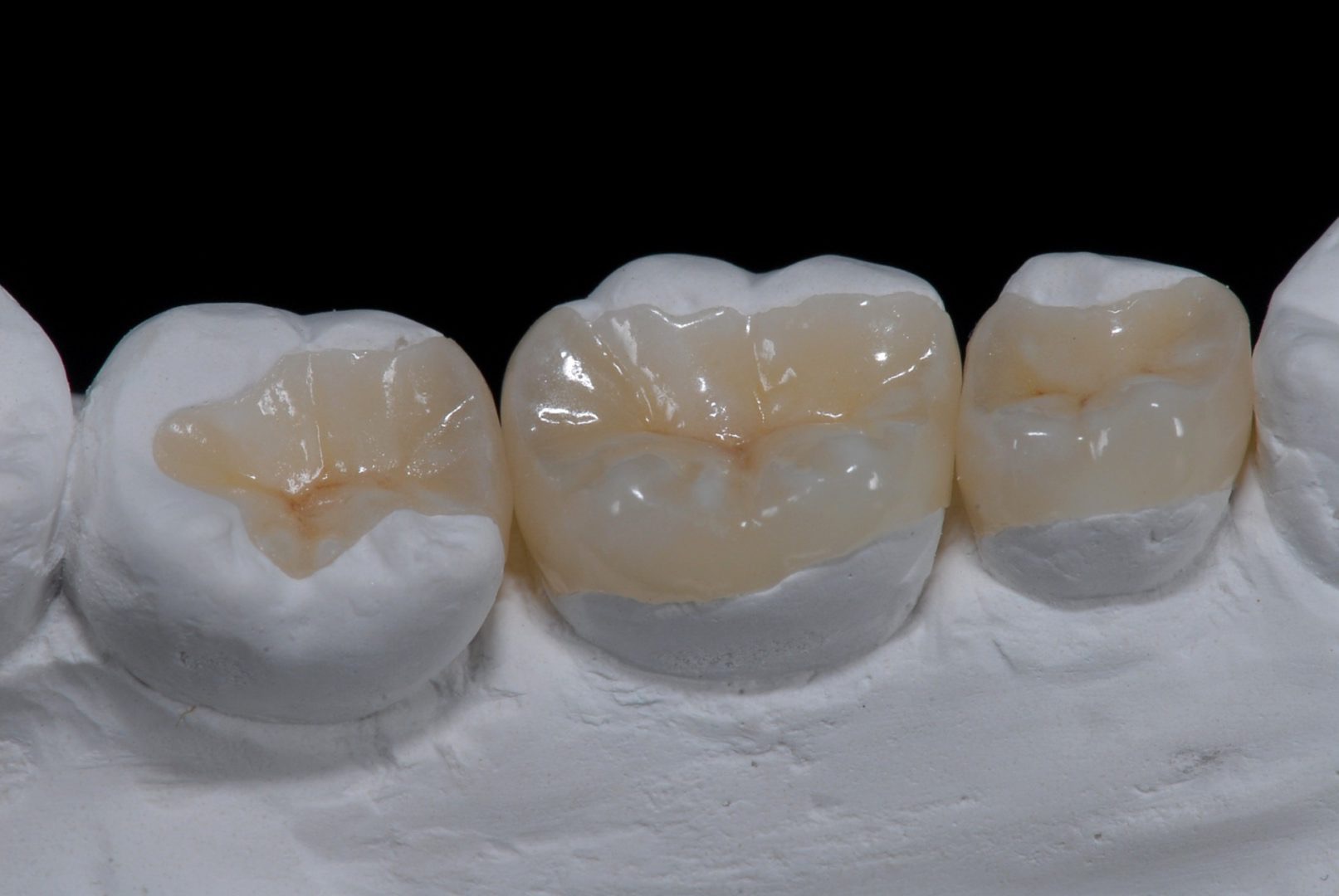 Dental Fillings