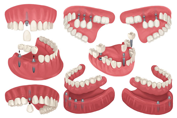 Dental Replacements